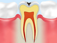 【エナメル質の虫歯】