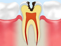 【象牙質の虫歯】
