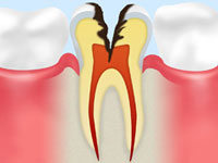 【神経まで達した虫歯】
