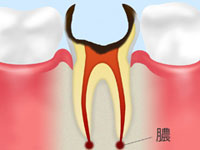 【歯根まで達した虫歯】