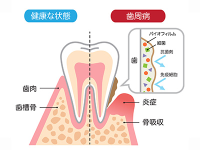 歯周病とは？