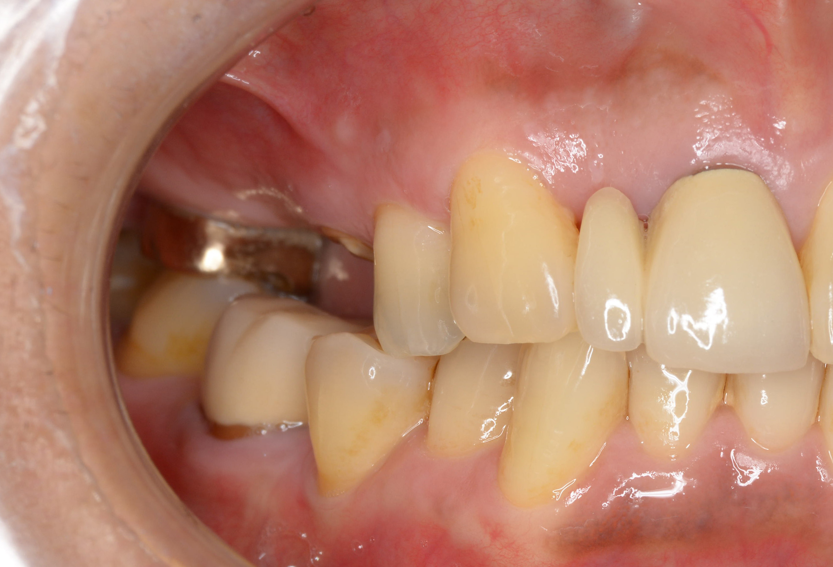 目立たないバネを用い審美的に治療した入れ歯症例