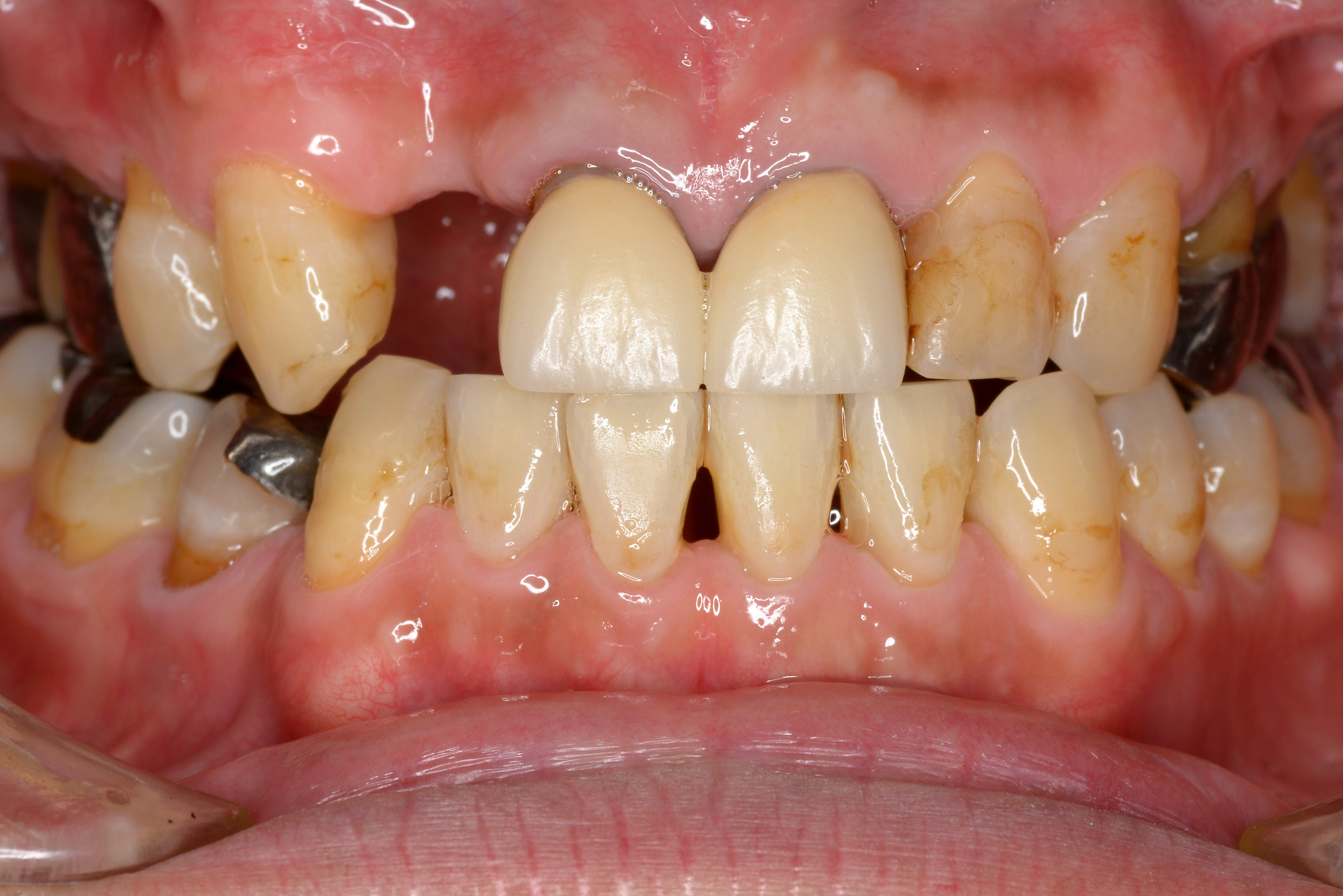 目立たないバネを用い審美的に治療した入れ歯症例　その2